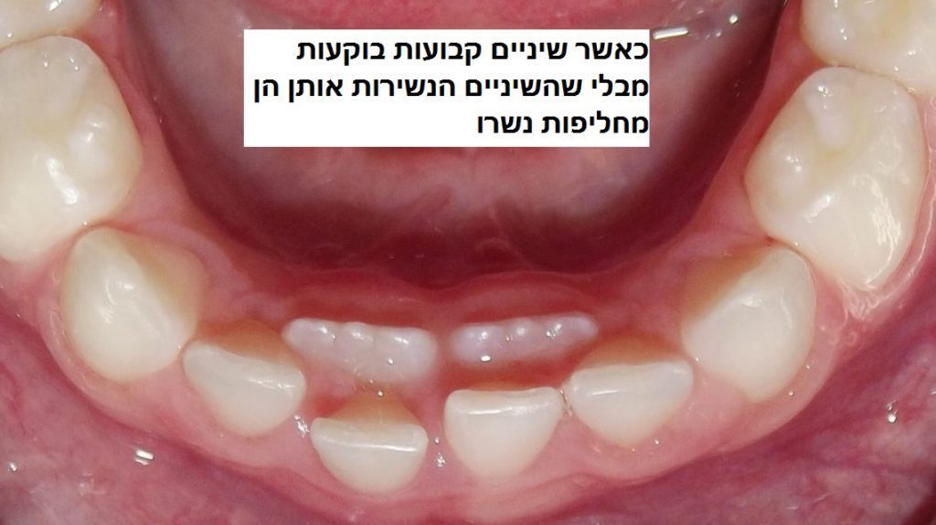 יישור שיניים לילדים