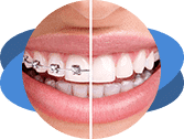 יישור שיניים אורתוגנטי